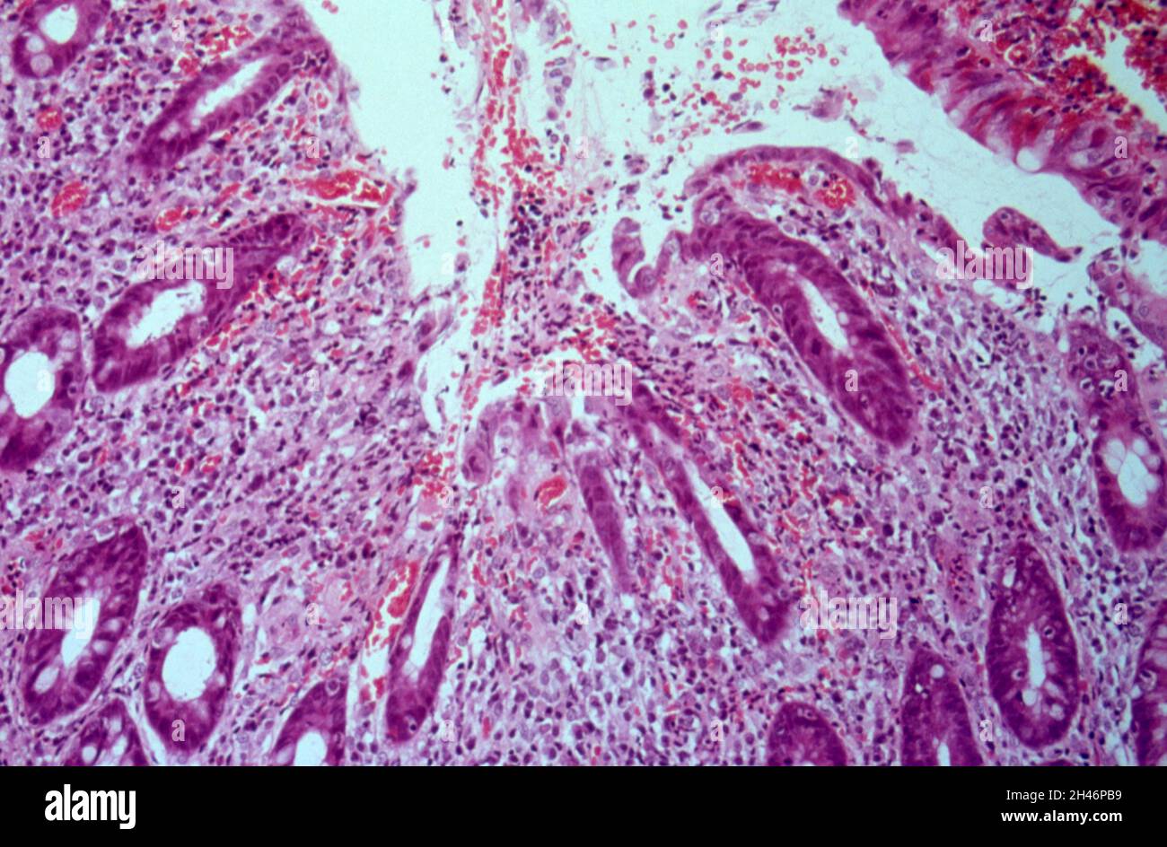 Amöbiasis: Dickdarm Stockfoto