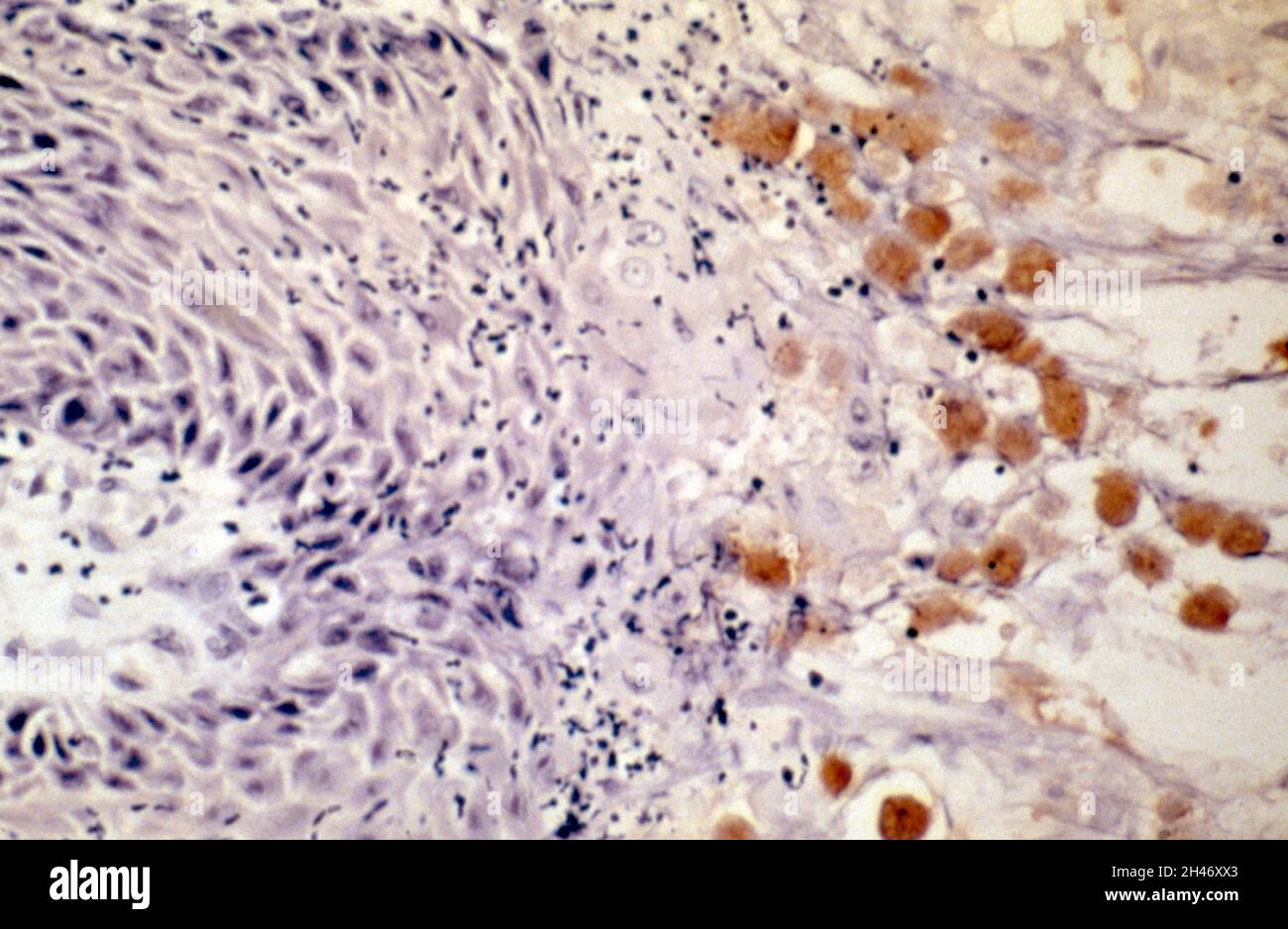 Amöbiasis: Haut Stockfoto