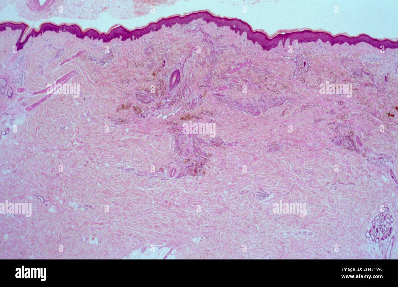 Kaposi-Sarkom mit HIV Stockfoto