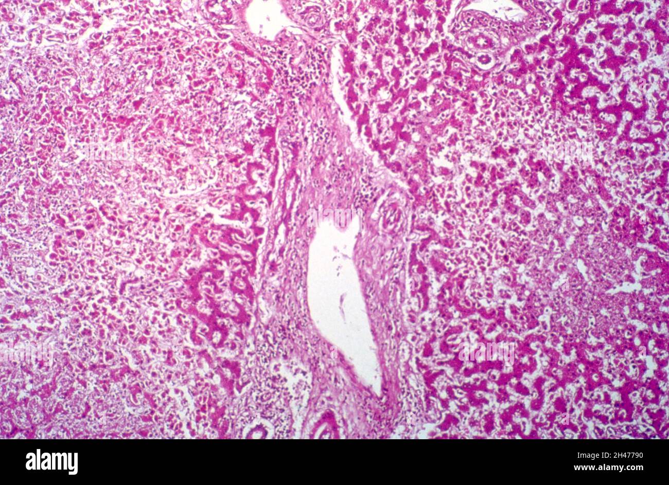 Amöbiasis: Amöbenabszess in der Leber Stockfoto