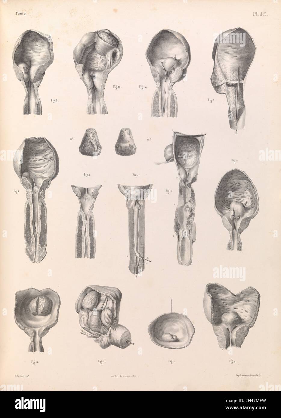 Platte 53. Pathologie der männlichen Genitalien, Harnorgane. Stockfoto