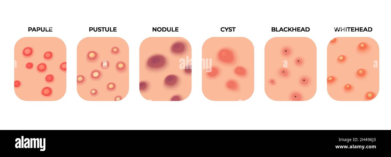 Akne-Typen. Infektionen des Gesichts, Pickel und Hautentzündungen. Hautpflege, Gesichtsakne Ausbruch. Dermatologie Epidermis Krankheit jüngsten Vektor-Set Stock Vektor
