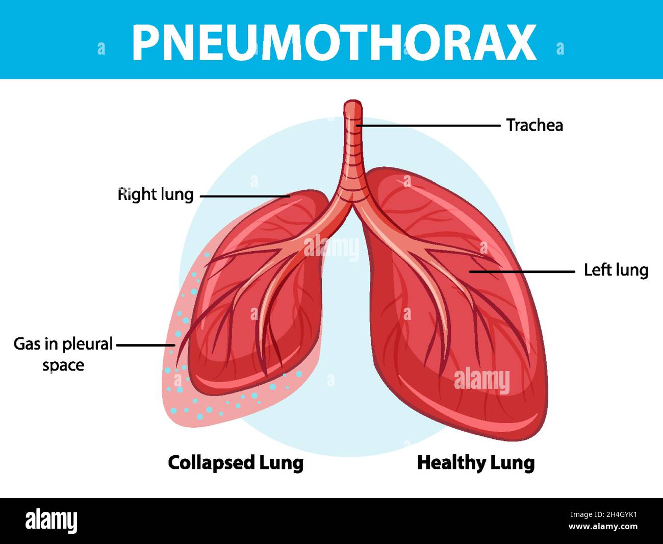 Pneumothorax-Diagramm mit eingestürzter Lunge und gesunder Lunge Stock Vektor