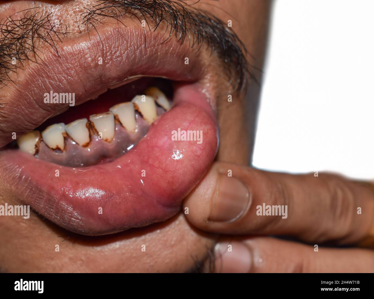 Abszess oder Zyste mit Eiter an der Unterlippe des asiatischen Mannes. Stockfoto