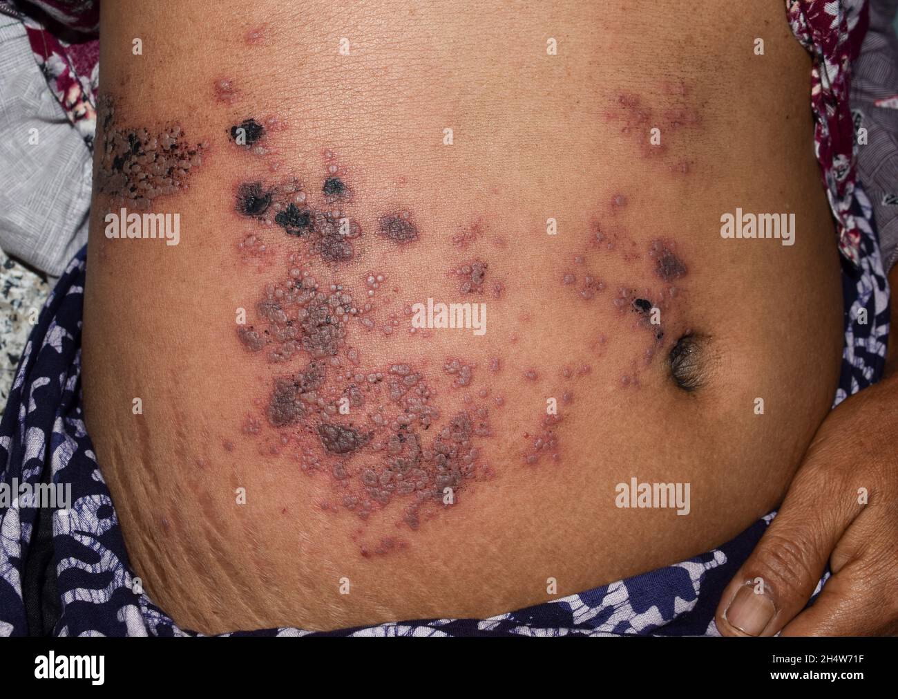 Herpes-Simplex-Infektion am Bauch der asiatischen Frau. Kleine und schmerzhafte Vesikel. Stockfoto