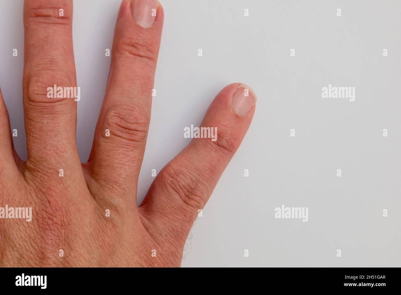 Erwachsene männliche Hand zeigt Verzerrung und Deformität des kleinen Fingers aufgrund einer Fehlbildung des Knochenbruchs Stockfoto