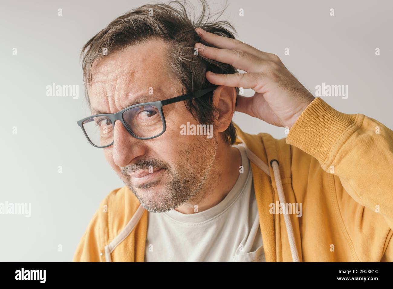 Haarausfall, Mann, der auf den Spiegel schaut, besorgt über den Verlust seines Haares an der Stirn, selektiver Fokus Stockfoto
