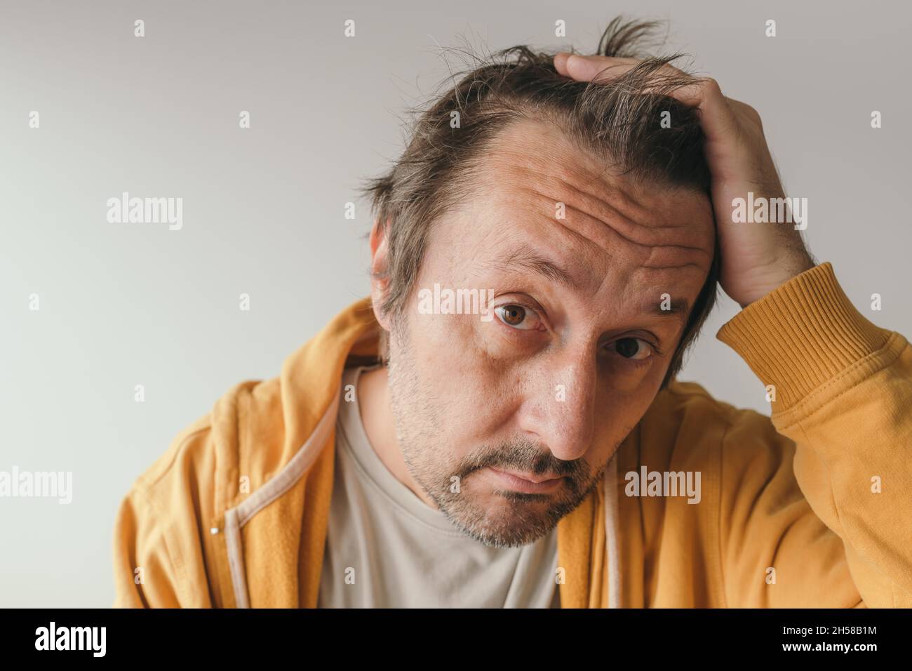 Haarausfall, Mann, der auf den Spiegel schaut, besorgt über den Verlust seines Haares an der Stirn, selektiver Fokus Stockfoto
