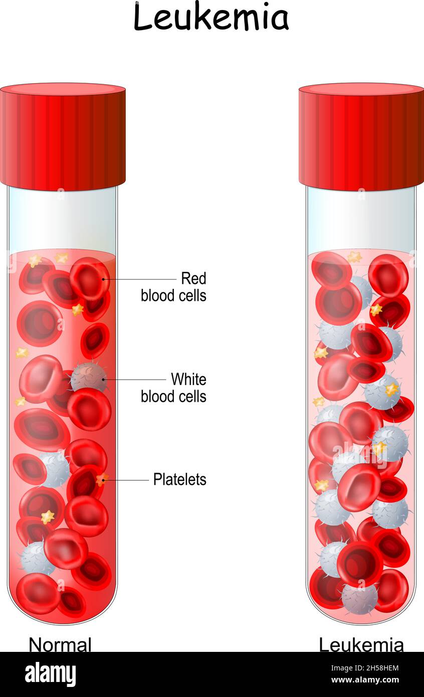Leukämie. Vergleichs- und Differenzteströhre mit normalem Blut und Blutkrebs. Nahaufnahme von roten Blutkörperchen und Lymphozyten. Vektorgrafik Stock Vektor