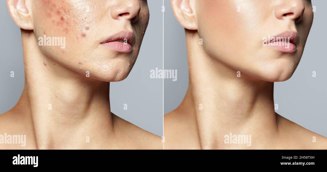 Teenager-Mädchen vor und nach Akne-Behandlung Hautpflege Konzept. Akne-Behandlung in einer Kosmetologie-Klinik Stockfoto