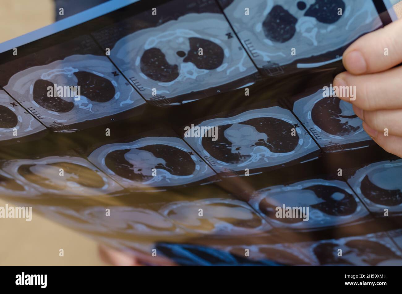 Die Hand eines Mannes hält den CT-Scan. Transversale Ansicht oder axiale Ebene der CT-Brust, die eine normale Untersuchung von Herz, Lunge, Wirbelsäule, Rippe usw. zeigt. Selektive Fokussierung Stockfoto