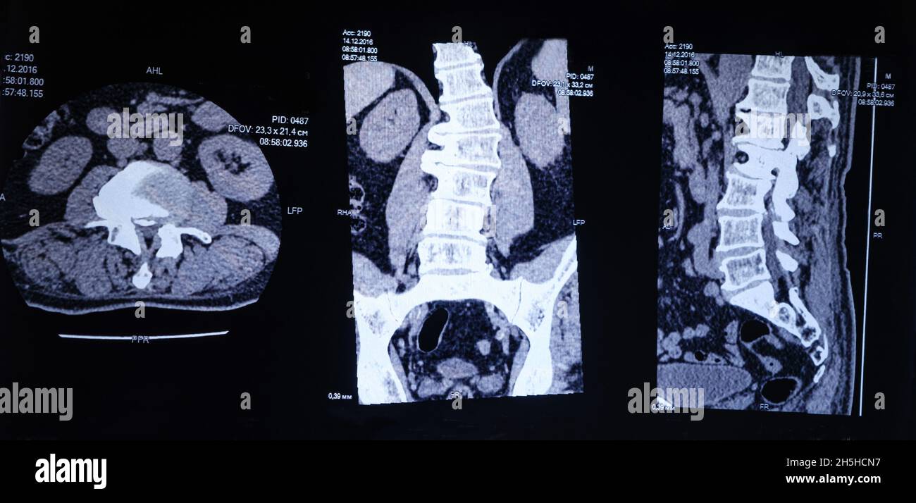 CT-Bild der Wirbelsäule eines Patienten mit Skoliose und Vorwölbung der Bandscheibe. Stockfoto