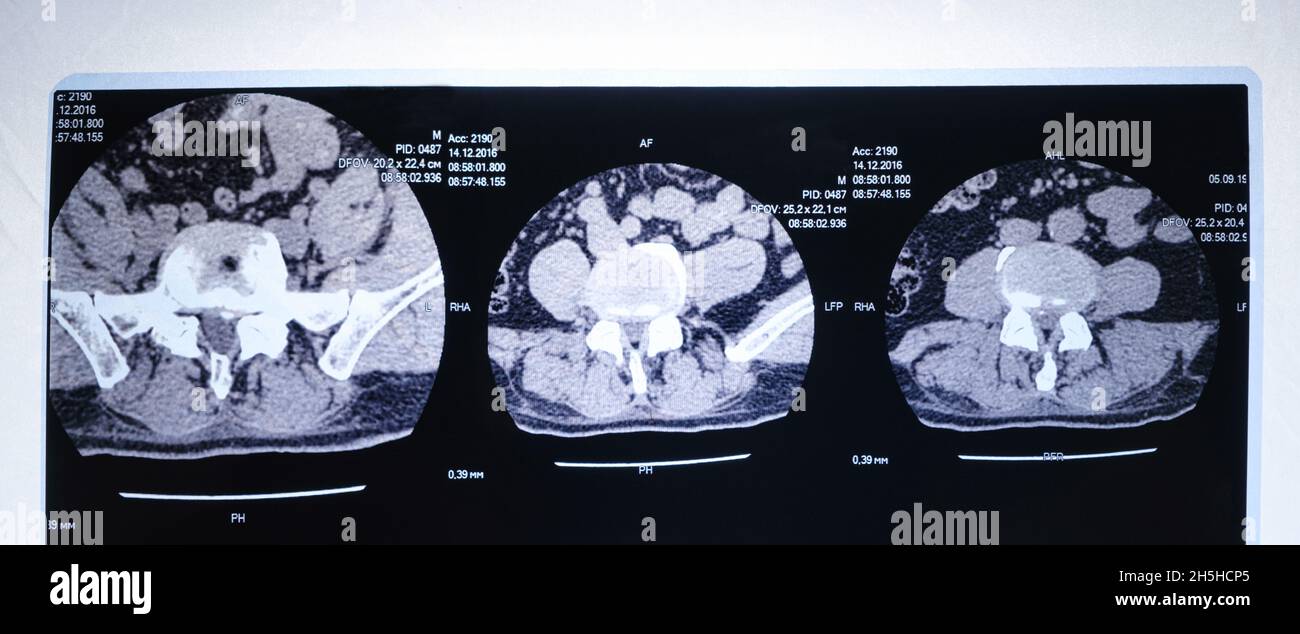 CT-Bild der Wirbelsäule eines Patienten mit Skoliose und Vorwölbung der Bandscheibe. Stockfoto