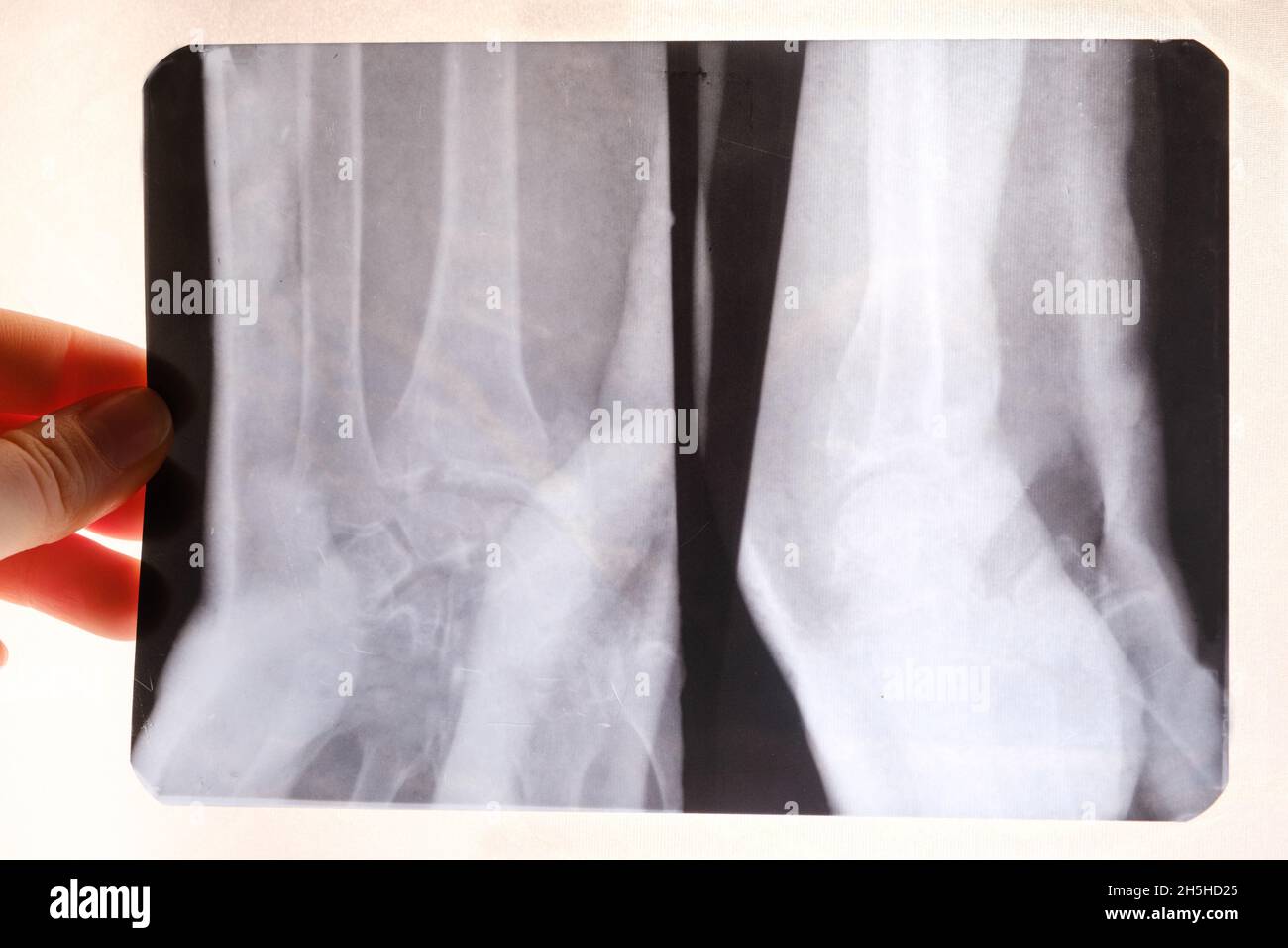 Röntgenaufnahme des Handgelenks einer Person, Riss oder Knochenbruch Stockfoto