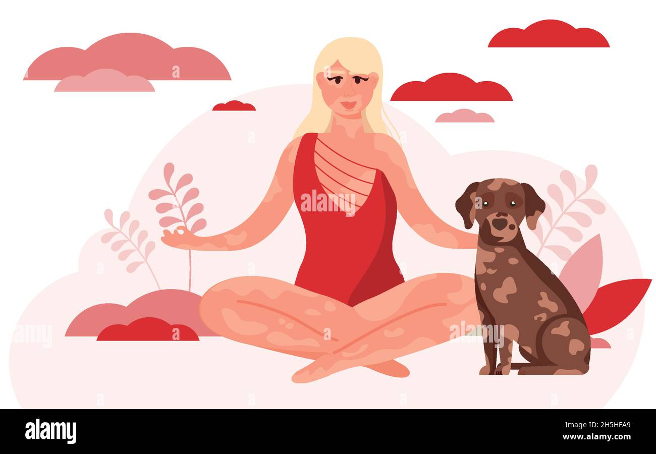 Junge blonde Frau mit Vitiligo Hautproblemen. Körper positiv, Selbstliebe, Depifermentation Krankheit. Stock Vektor
