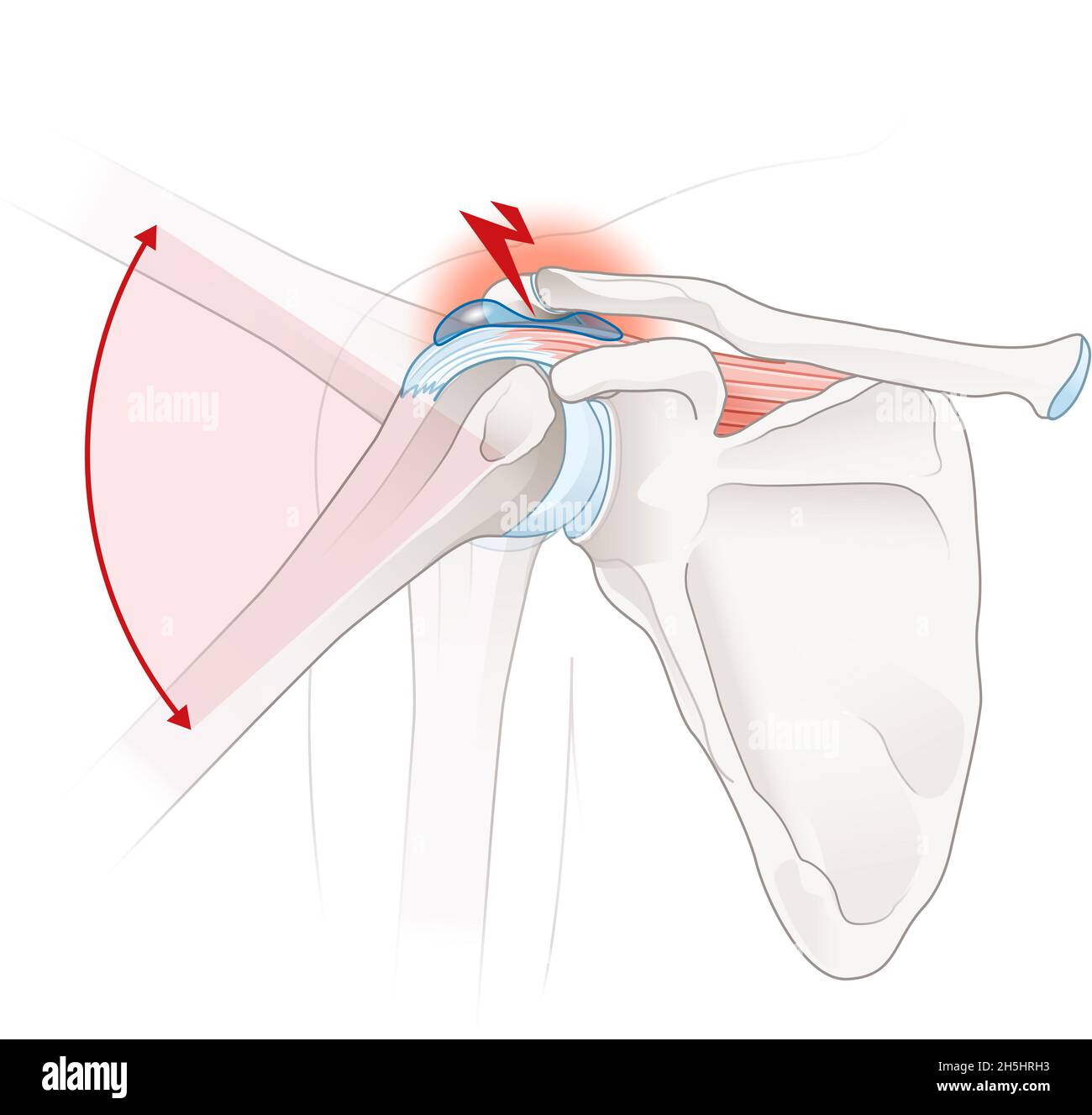 Orthopäde Für Schulter In Der Nähe Schulter impingement syndrom -Fotos und -Bildmaterial in hoher