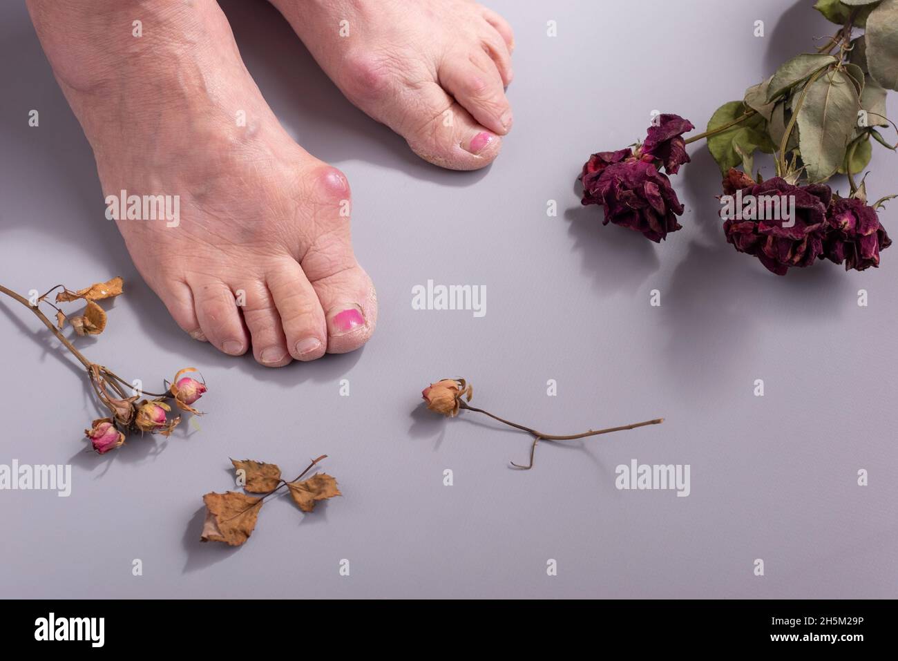 Konzept der Fußkrankheit bei alter Frau mit trockenen Blumen Stockfoto
