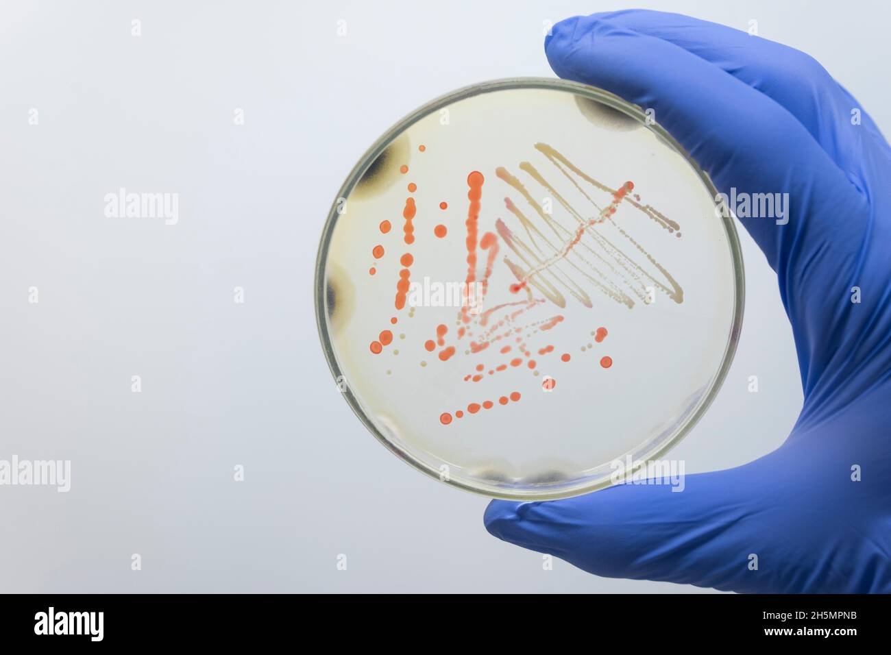 Der Wissenschaftler hält eine Petrischale mit pathogenen Kolonien von orangen und gelben Bakterien mit seiner Handschuhen in der Hand. Isolierung von Bakterien vom Menschen. Stockfoto