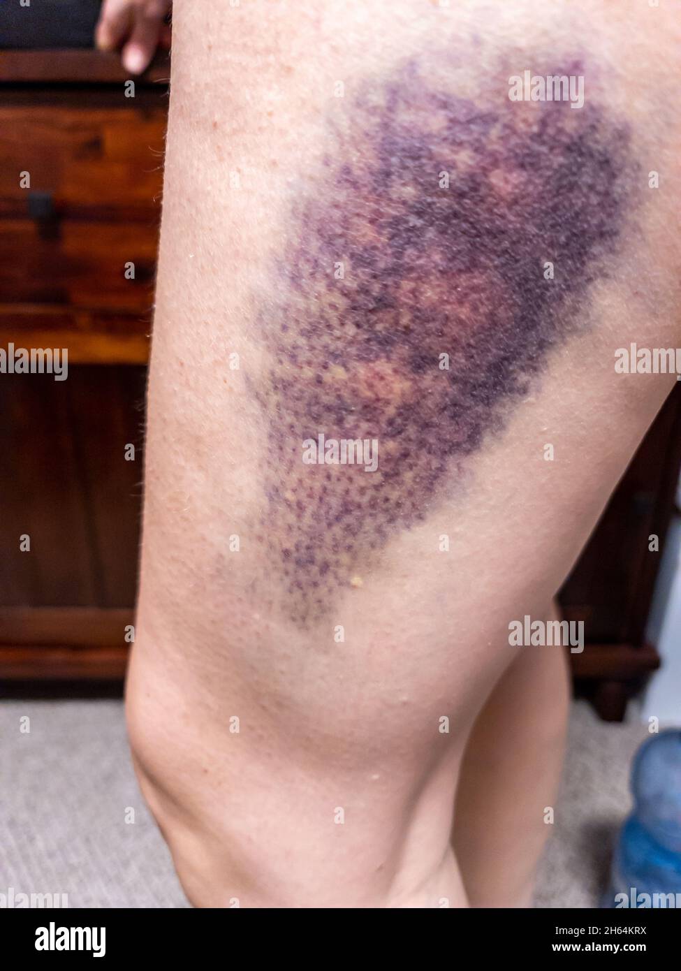 Große, farbige Blutergüsse am Oberschenkel. Hämatom. Stockfoto