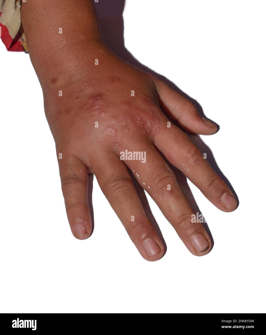 Einseitiges Ödem mit Krätze der oberen Extremität. Geschwollene Hand und Arm des asiatischen Kindes. Stockfoto
