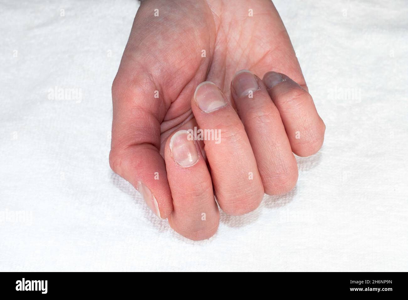 Nahaufnahme einer kaukasischen Frauenhand mit natürlich unpolierten Nägeln, überwucherten Nagelhaut auf weißem Hintergrund, Draufsicht, Kopierraum. Natürliche Nägel konce Stockfoto