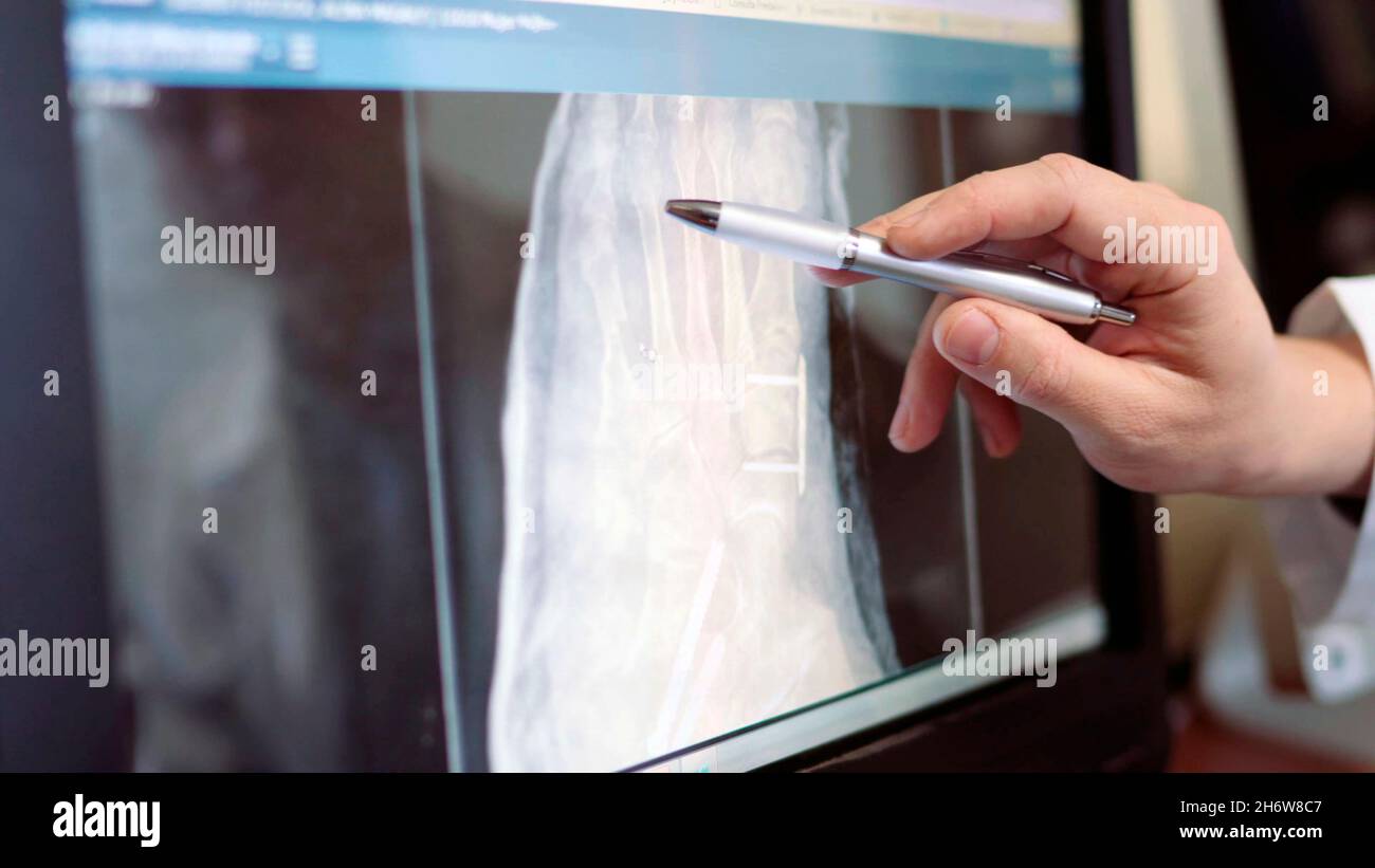 Nahaufnahme der Hand eines Arztes, die mit einem Kugelschreiber auf eine Hand-Röntgenaufnahme zeigt Stockfoto
