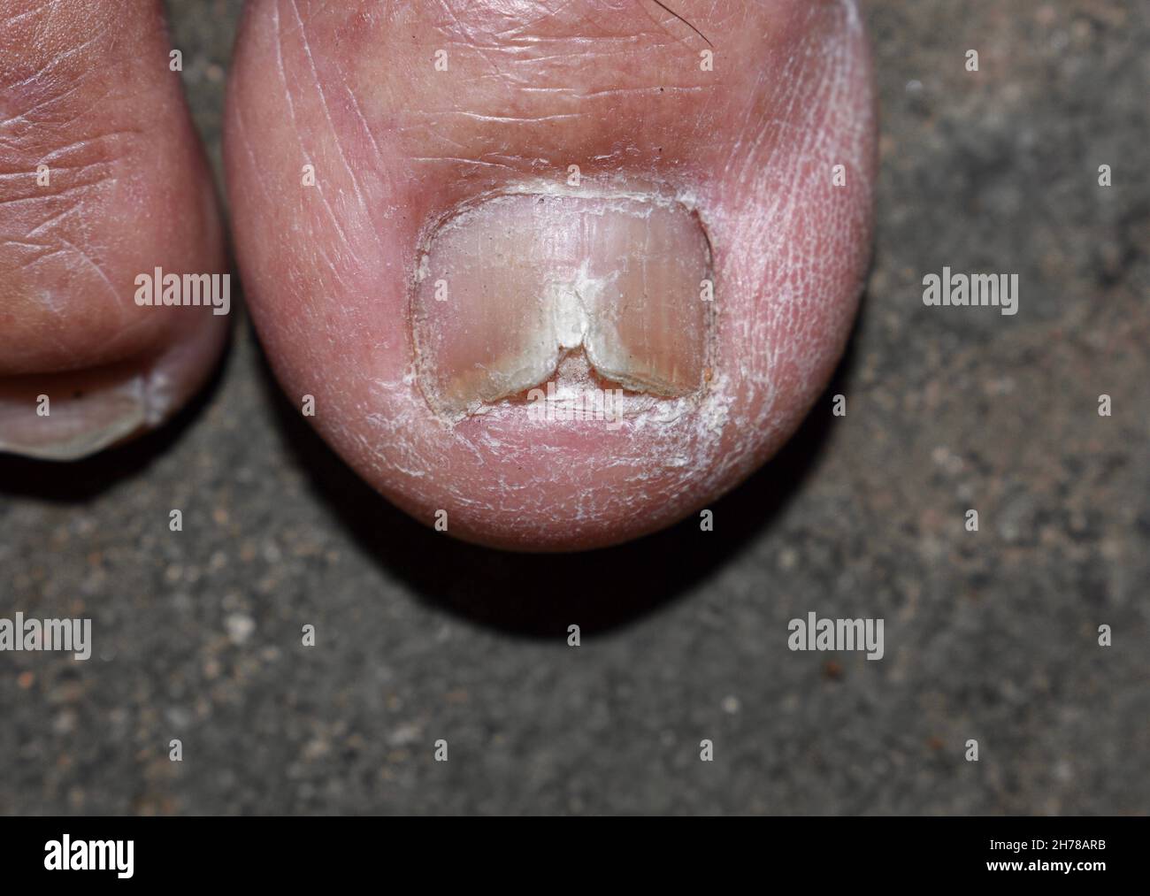 Beschädigter und rissiger Zehennagel. Pilznagelinfektion. Onychomykose, auch Tinea unguium genannt. Stockfoto