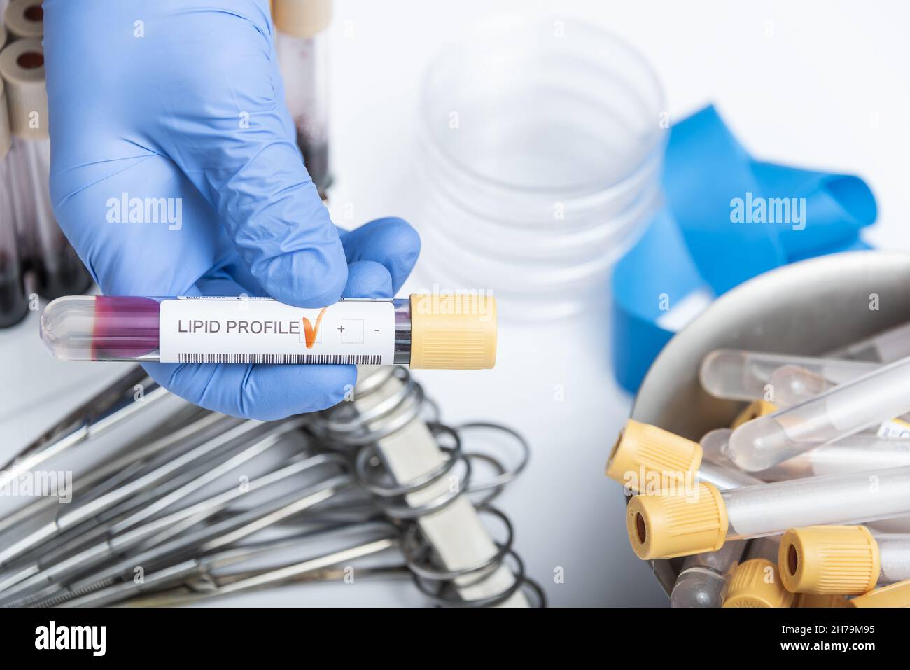 Blutprobe für Lipidprofil-Tests. Medizintechnik Stockfoto