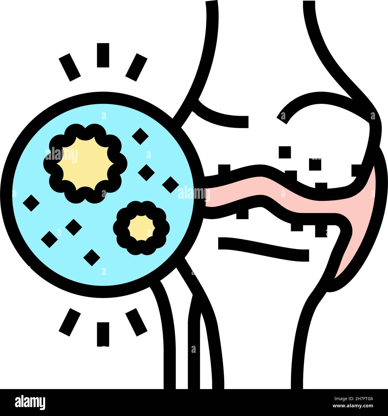 Vektor-Illustration mit Symbolen für infektiöse Arthritis Stock Vektor