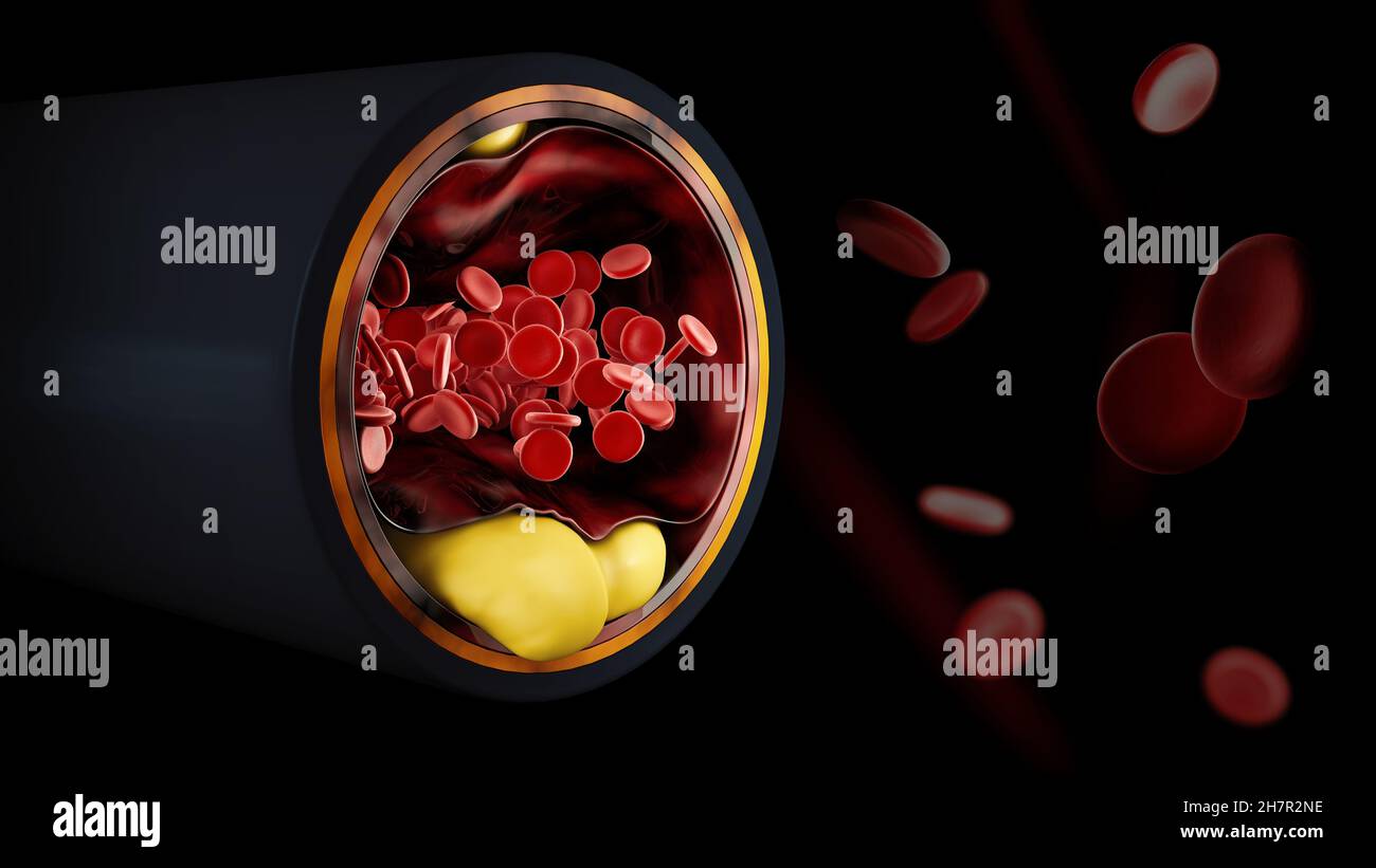 3D Illustration von Blutzellen mit Plaque-Aufbau von Cholesterin Symbol für vaskuläre Erkrankung. Beschneidungspfad enthalten Stockfoto