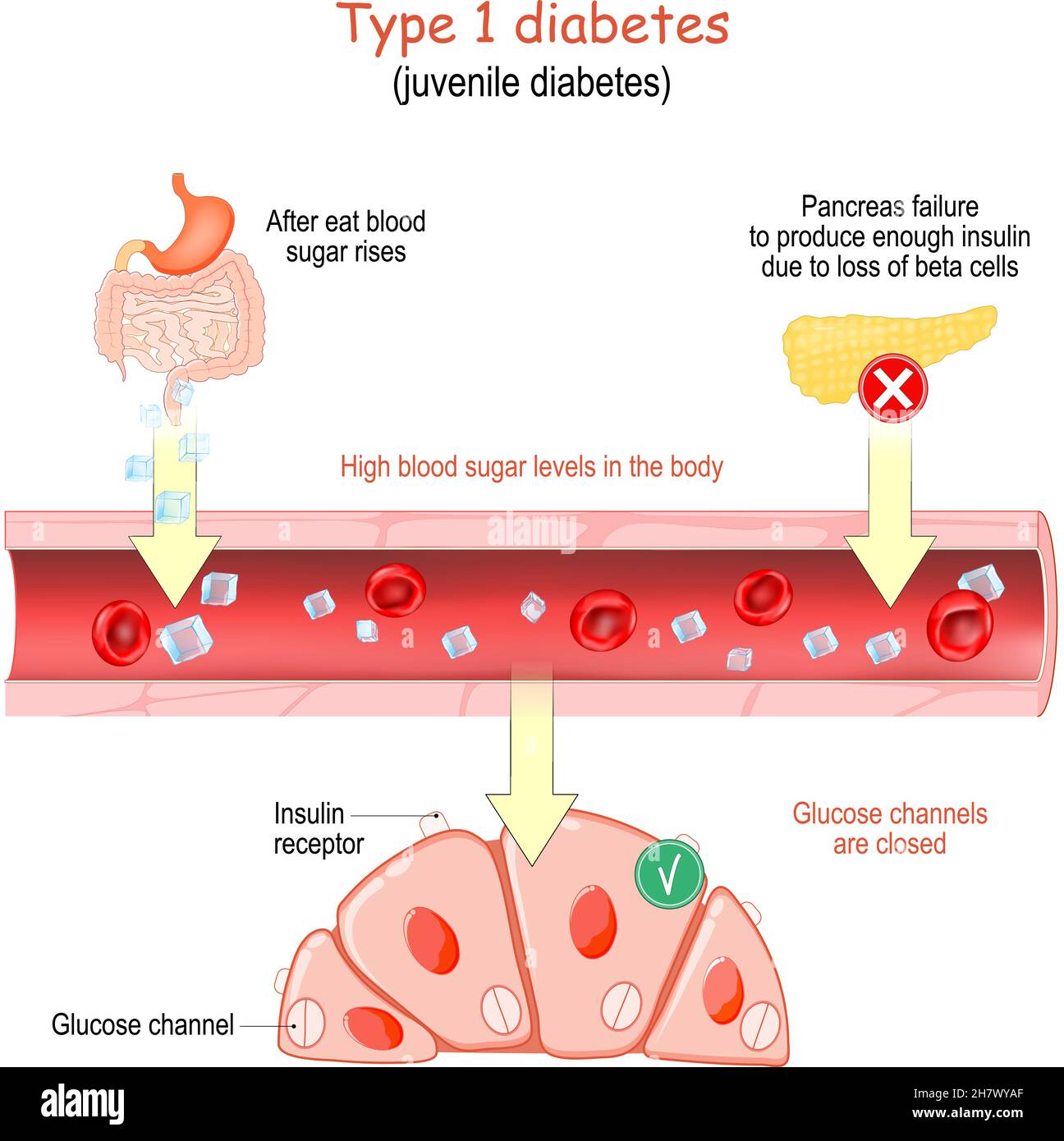 Typ-1-Diabetes. Jugenddiabetes. Hoher Blutzuckerspiegel im Körper. Die Glukosekanäle in den Zellen sind geschlossen. Vektor-Poster für Bildungs-und m Stock Vektor