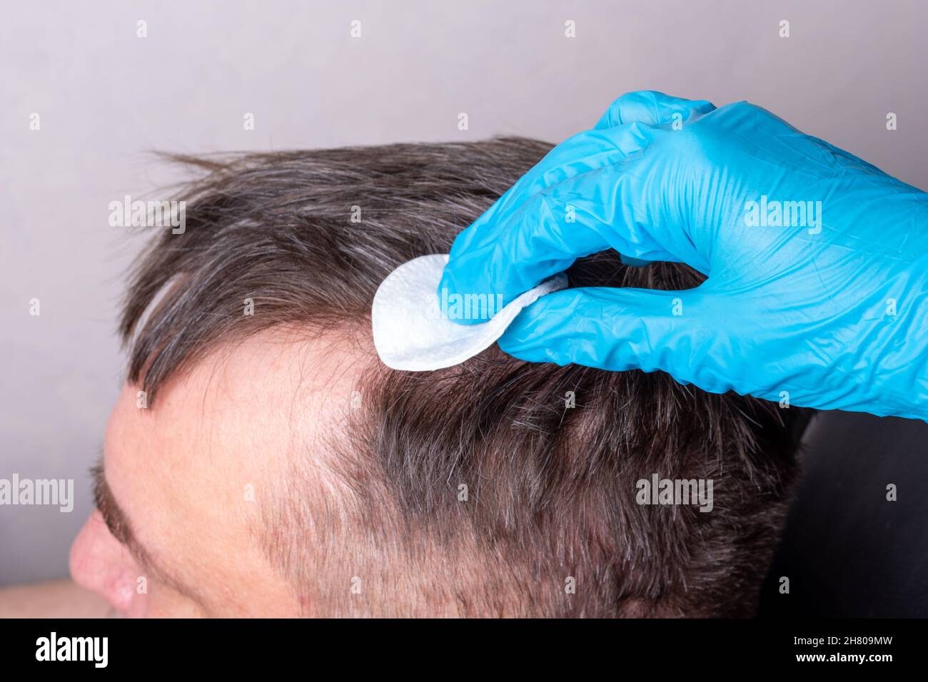 Behandlung von menschlichem Haarausfall nach Coronavirus. Ein Arzt in blauen medizinischen Handschuhen untersucht das Haar und die Kopfhaut eines Mannes, wischt es mit einem Wattepad, clos Stockfoto