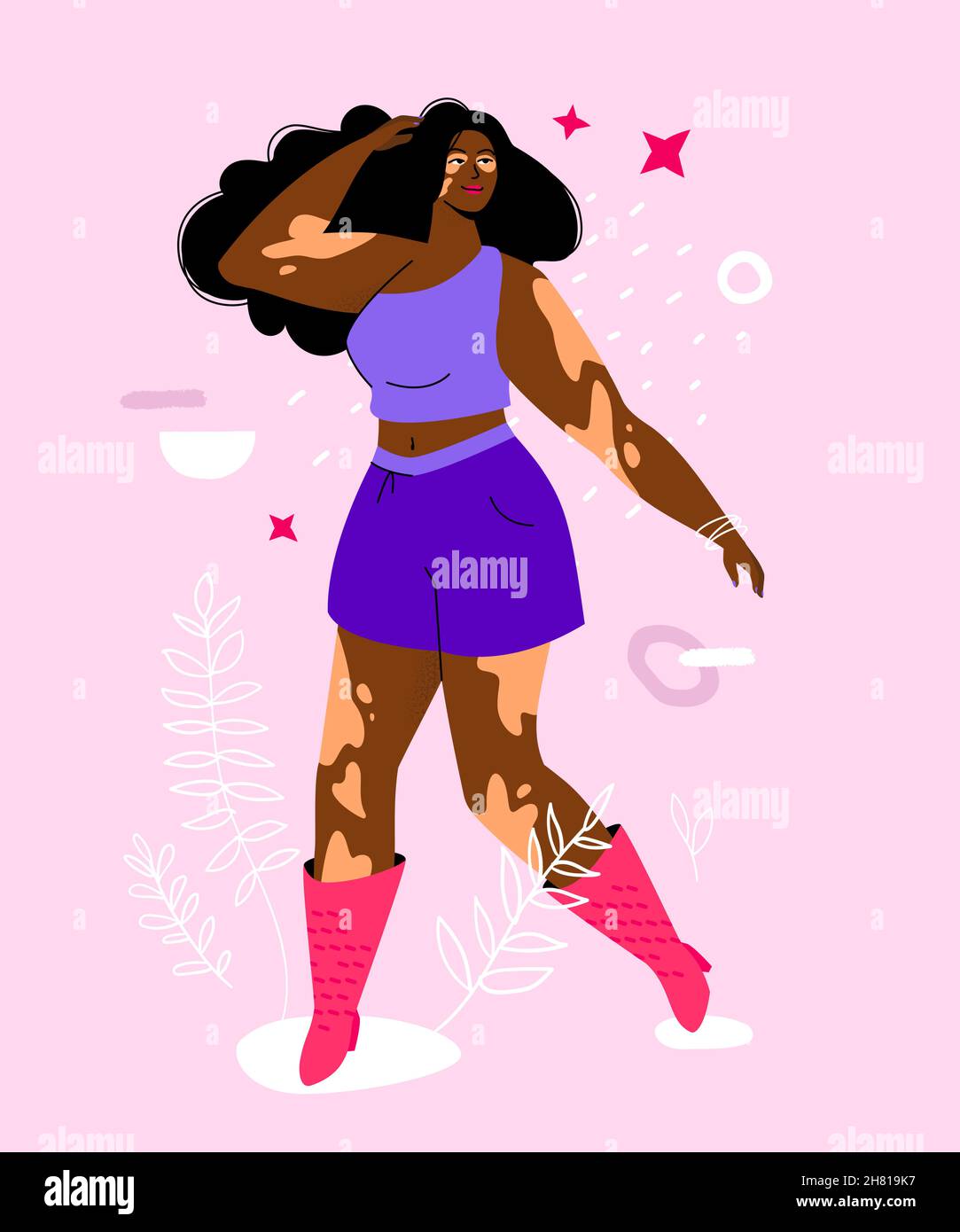 Seien Sie nicht schüchtern über Vitiligo - bunte flache Design Stil Illustration. Starke unabhängige Frau in lila Shorts und T-Shirt fühlen sich selbstbewusst. Sie k Stock Vektor