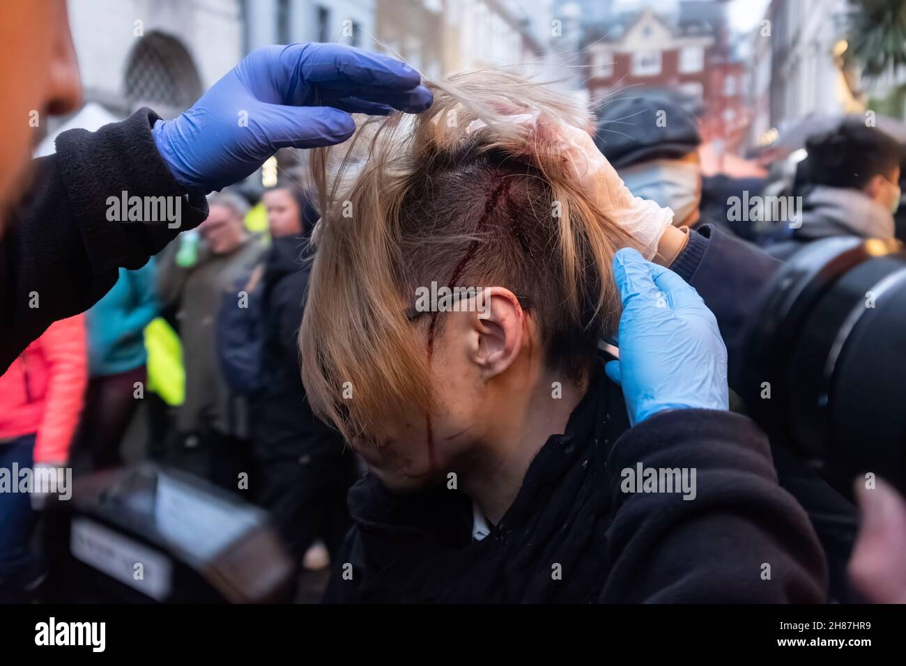 (ANMERKUNG DER REDAKTION: Das Bild enthält grafische Inhalte) Blutige Verletzungen, die auf einem Kopf eines Hongkonger nach einem Gezänk zwischen Pro-Peking-Teilnehmern und Hongkonger Demokratieprotesten während der Kundgebung gesehen wurden. Die von Pro-Pekinger Demonstranten organisierte „Anti-Asiatische Hate“-Kundgebung und die von Hongkonger Demokratiedemonstranten organisierte „Lunch with You“-Kundgebung versammeln sich getrennt am gleichen Ort in Chinatown in London. Während die Pro-Pekinger Gruppe kein antiasiatisches Hass rief, kam Hongkongers mit Widerstand gegen die Kommunistische Partei Chinas (KPCh) und Nein zum Völkermord zurück. (Foto von May James / SOPA Images/Sipa USA) Stockfoto