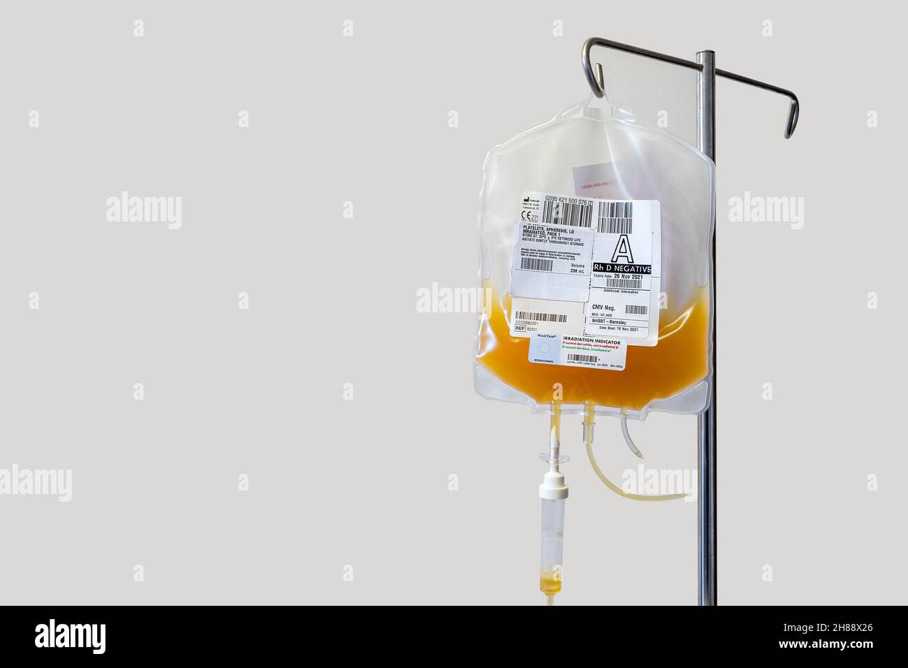 Beutel mit Blutplättchen, die als Teil einer Thrombozytentransfusion für die Chemotherapie-Behandlung aufgehängt werden. Nahaufnahme mit Kopierbereich. Stockfoto