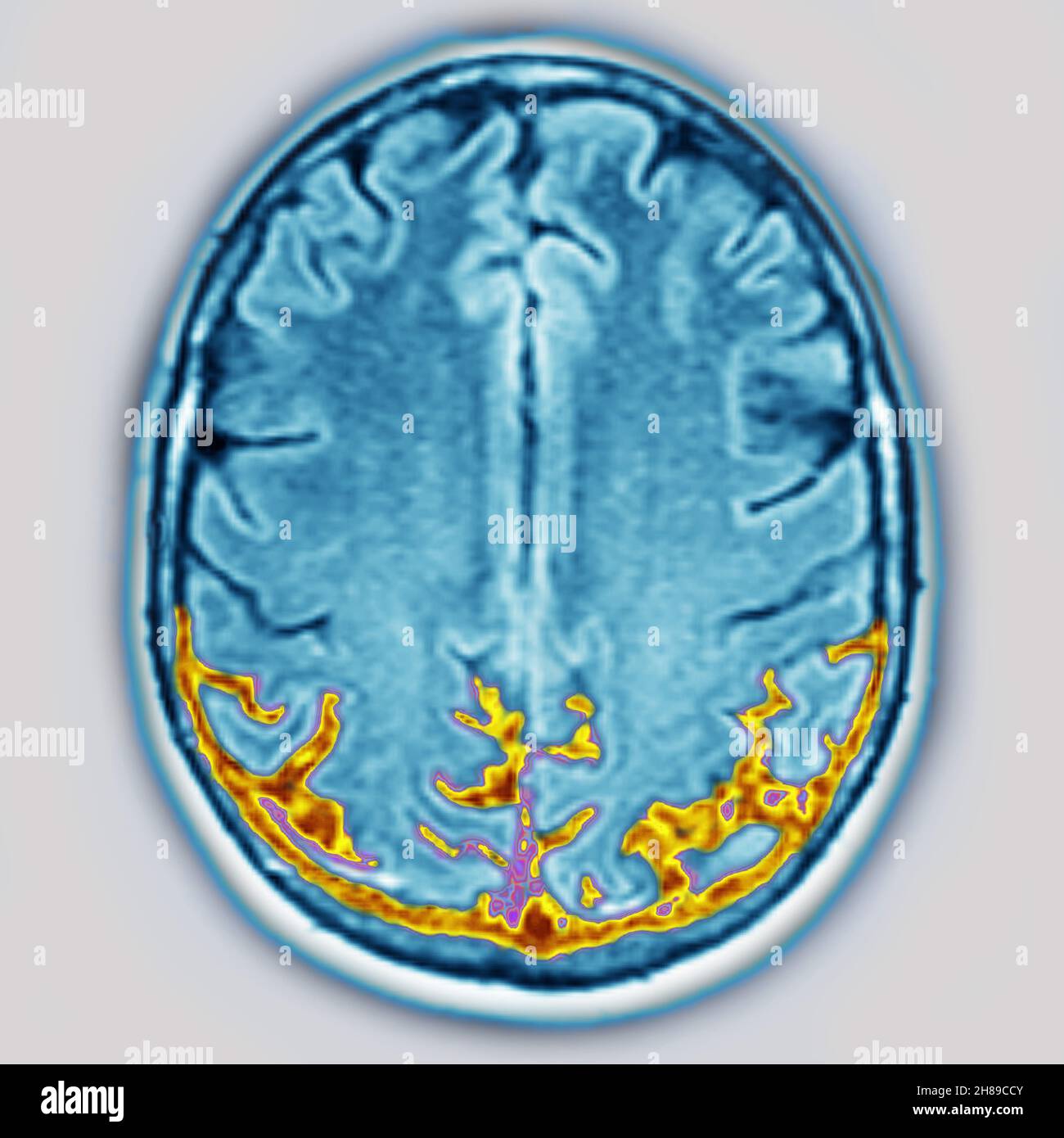 Zerebrale Atrophie Stockfoto