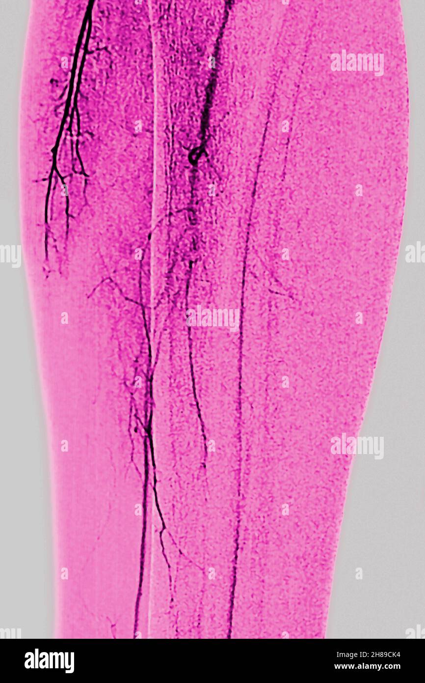 Arteriitis der unteren Gliedmaßen Stockfoto