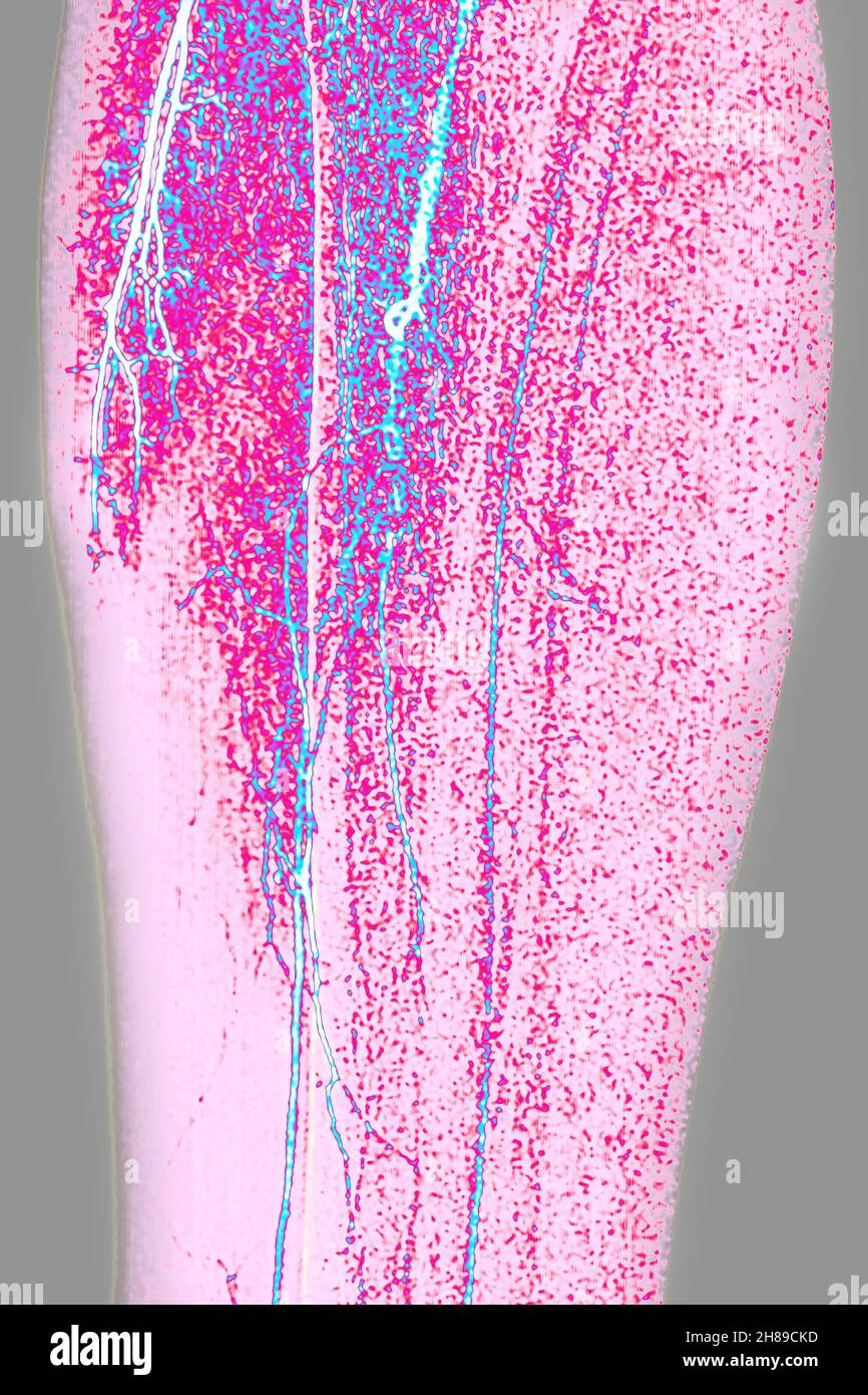 Arteriitis der unteren Gliedmaßen Stockfoto