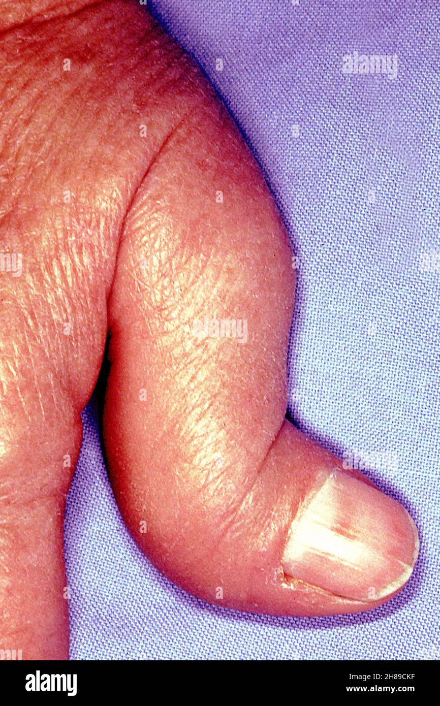 Rheumatoide arthritis Stockfoto