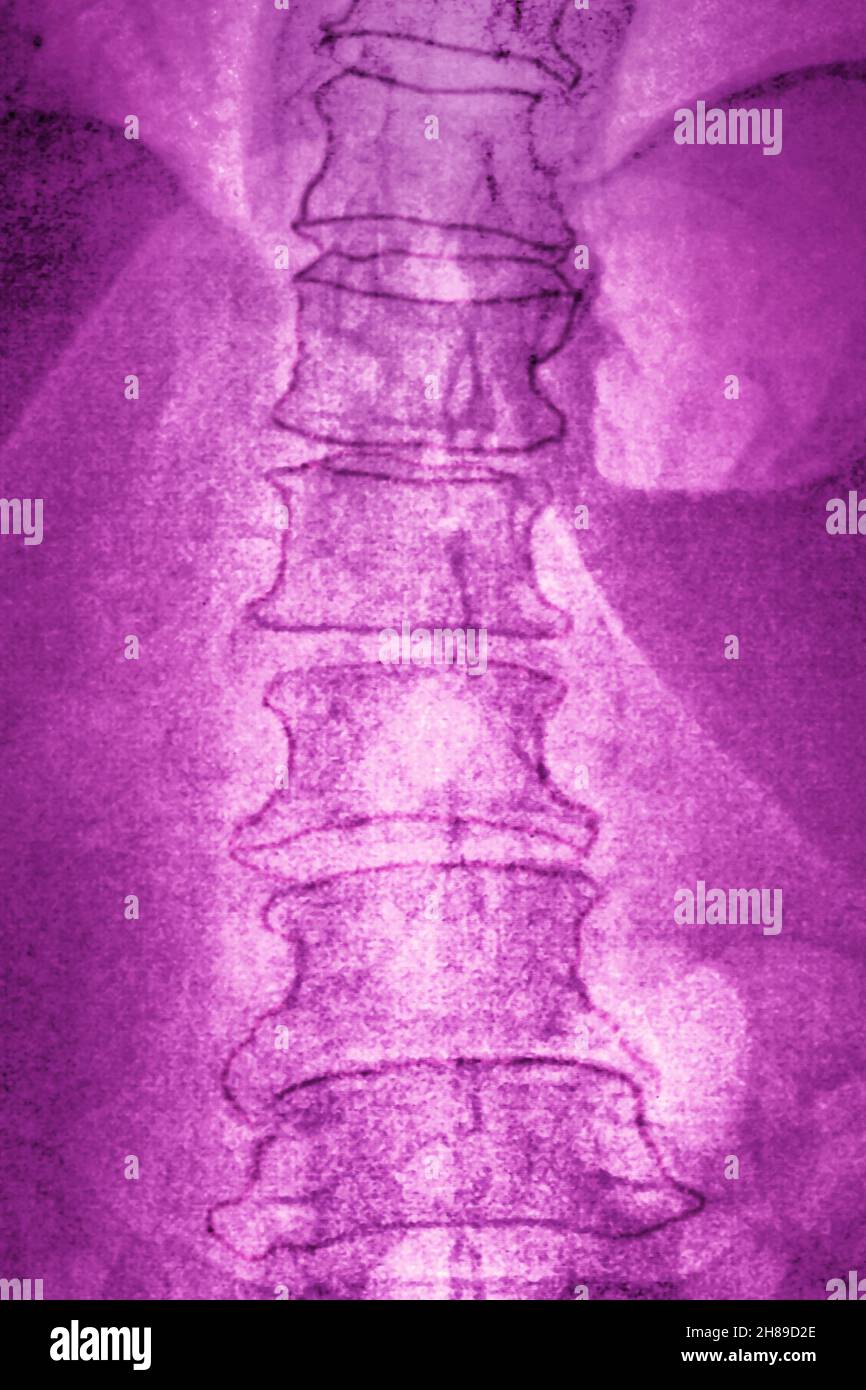 Degenerative Bandscheibenerkrankung der Lendenwirbelsäule Stockfoto Degenerative Bandscheibenerkrankung der Lendenwirbelsäule Stockfoto