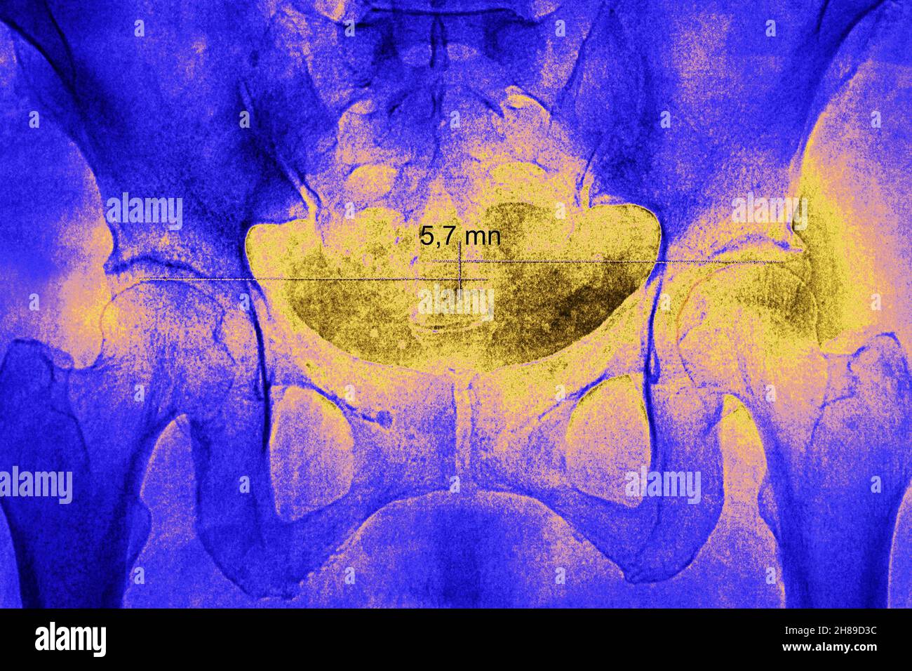 Hüftasymmetrie Stockfoto
