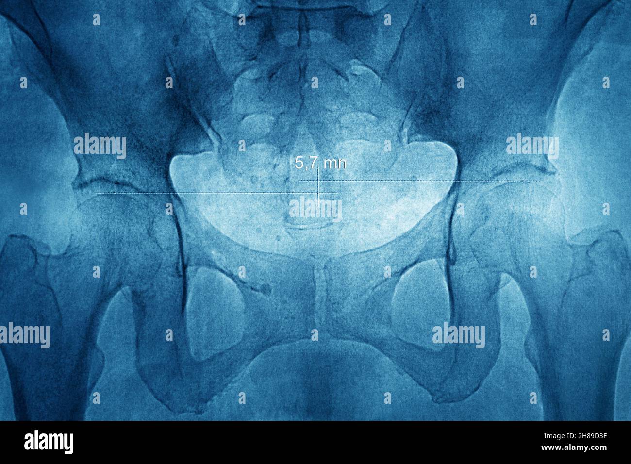Hüftasymmetrie Stockfoto