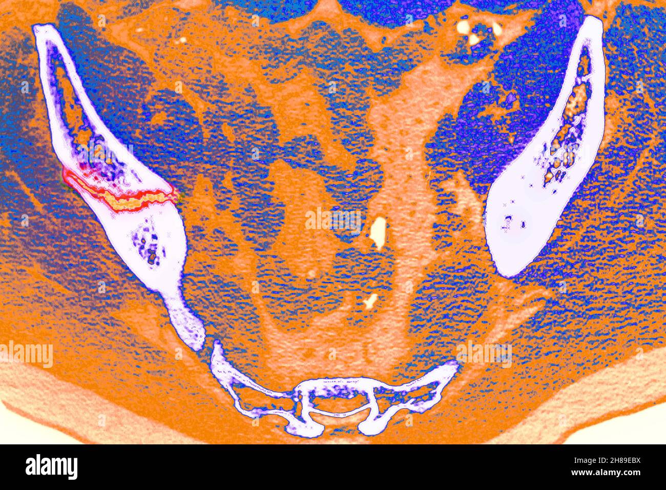 Hüftfraktur Stockfoto