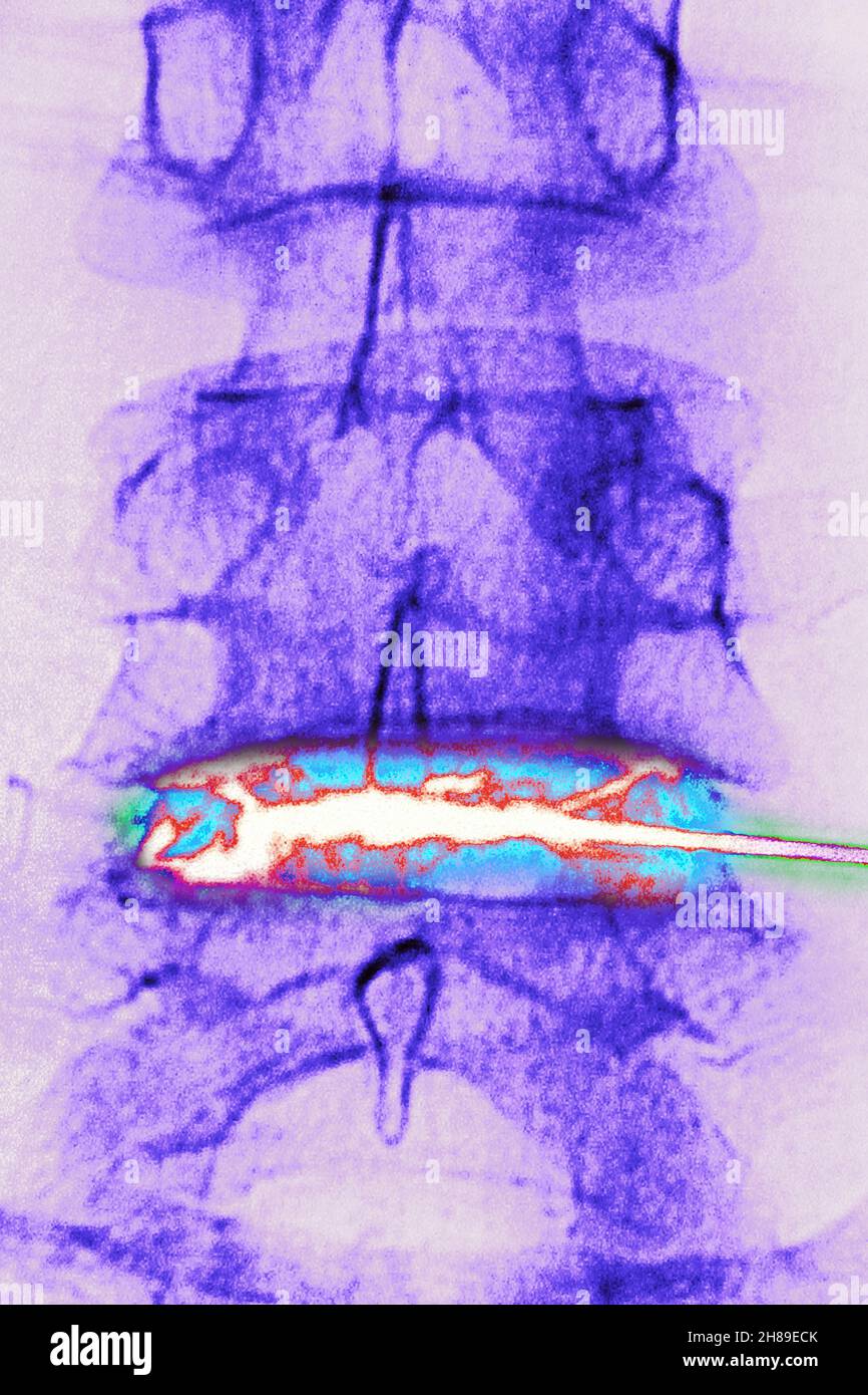 Corticosteroid-Infiltration Stockfoto