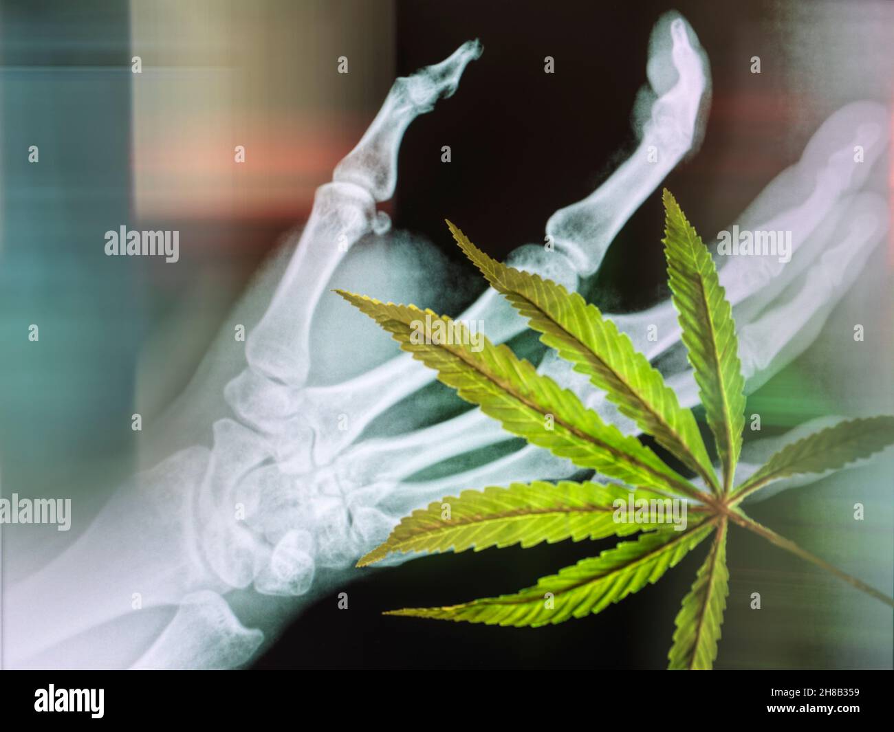 Cannabisblatt und Bonescan als mögliche Kuration für Arthritus Stockfoto