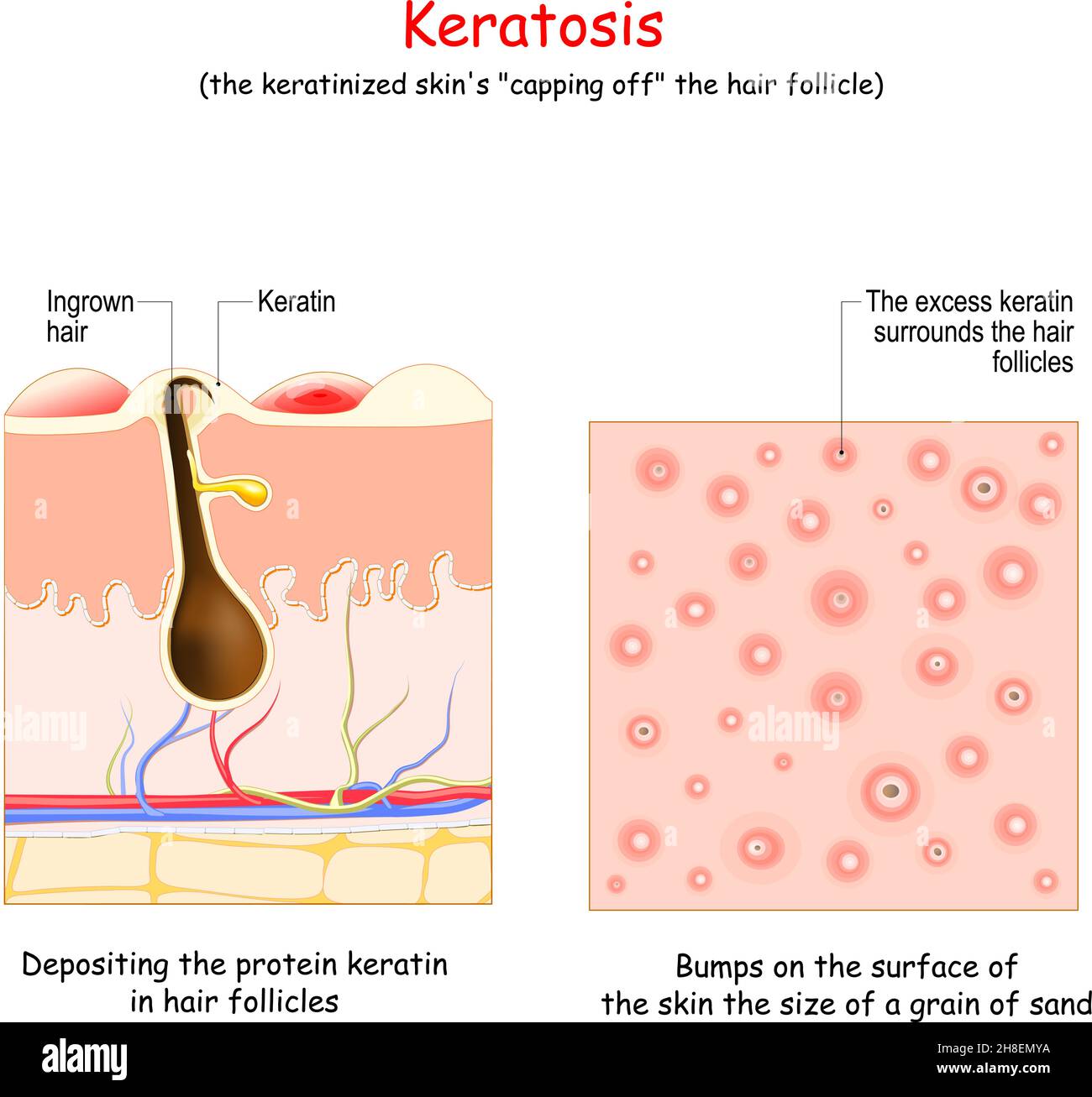 Keratose. Hauterkrankung. Draufsicht mit Ablagerung des Proteins Keratin in Haarfollikeln. Und Querschnitt der menschlichen Haut mit Beulen auf der Oberfläche der Stock Vektor