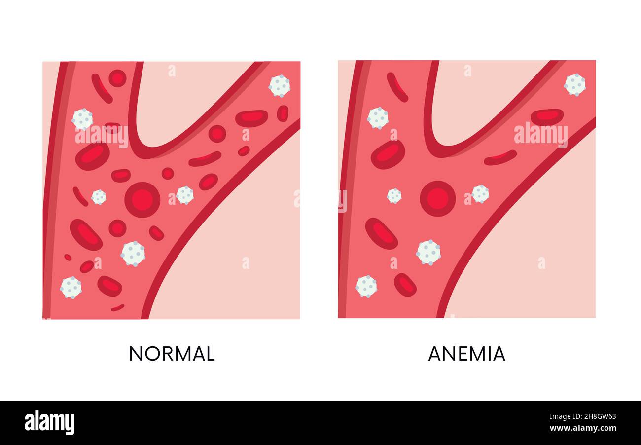 Normale und Anämie Menge der roten Blutkörperchen in Blutbild. Eisenmangelanämie. Abnahme der Gesamtmenge der Erythrozyten oder des Hämogogoins Stock Vektor