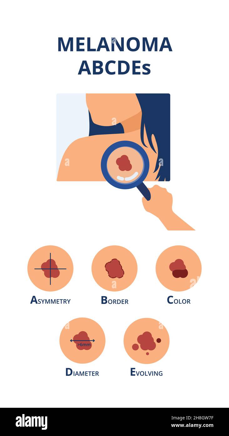 Die Symptome des ABCDE-Melanooms sind wie großer Durchmesser, Asymmetrie, unebene Farbe, unebene Grenze und entwickeln sich neben der Hand des Arztes, der Hautkrebsfleck erkennt Stock Vektor