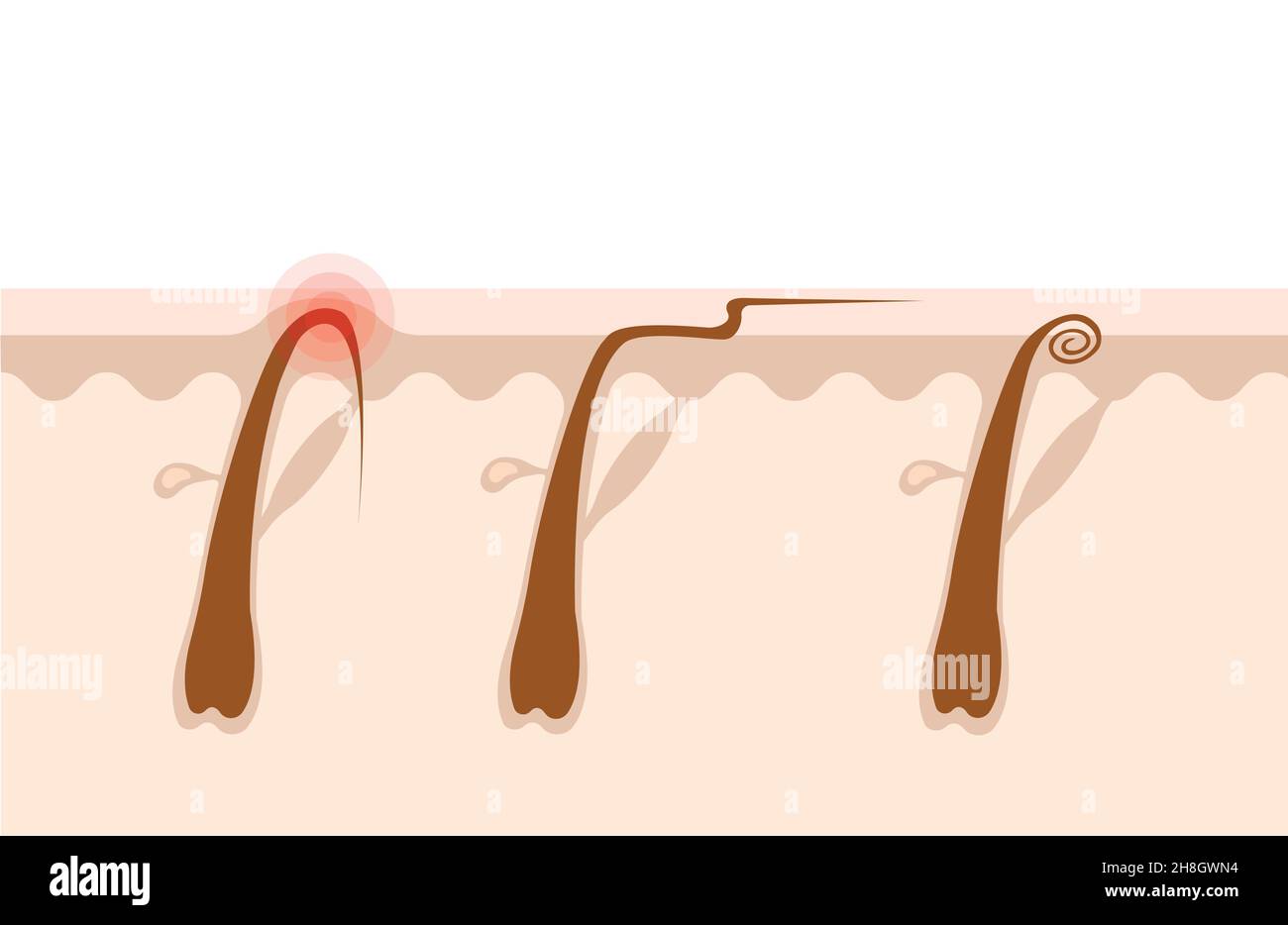 Arten von eingewachsenen Haaren flache Abbildung. Querschnitt der menschlichen Haut mit Haarfollikeln. Haarentfernungskonzept. Rasur, Enthaarung, Kosmetologie Stock Vektor
