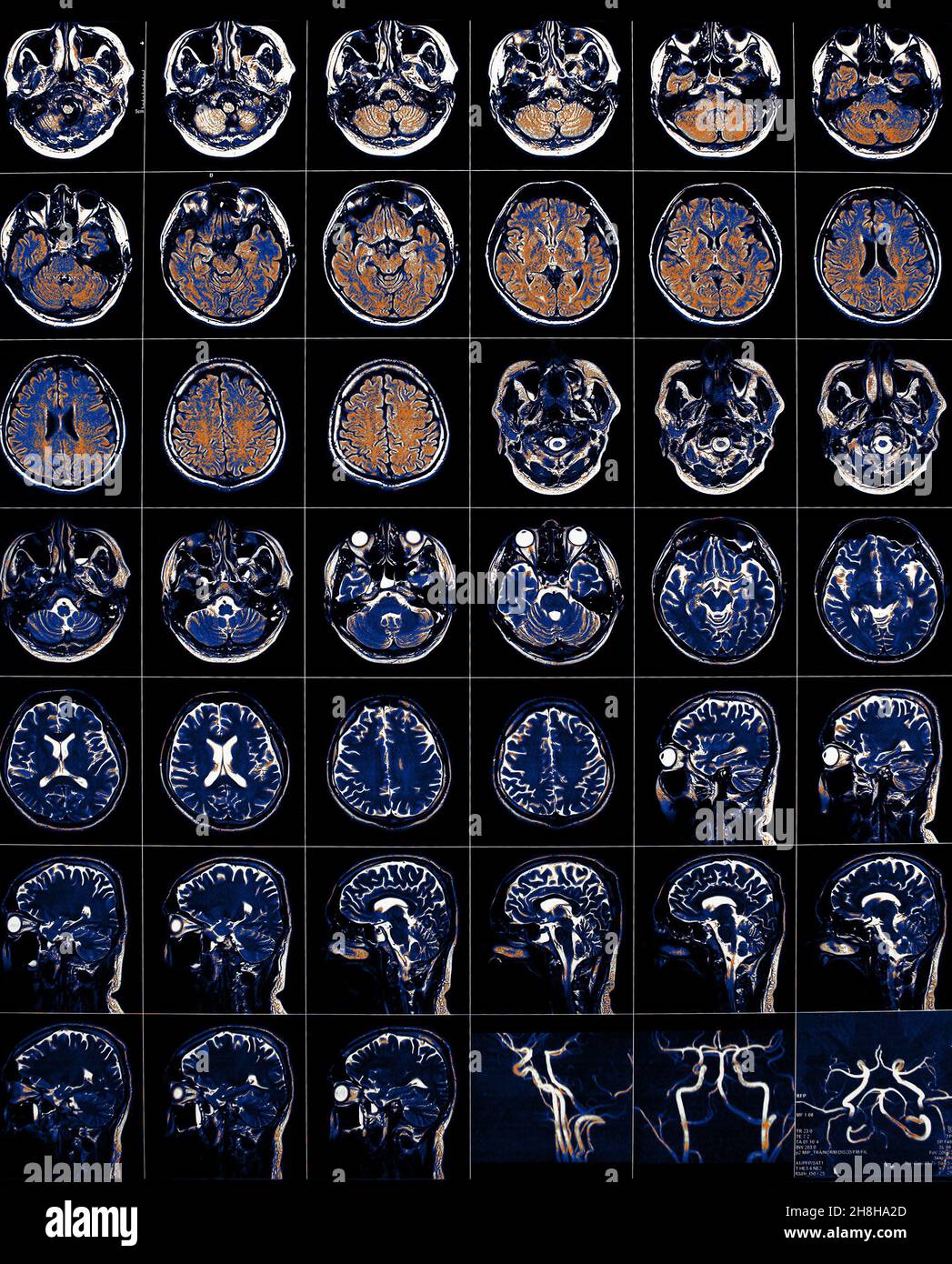 CT-Film von menschlichen Gehirn- und Schädelknochen. Stockfoto